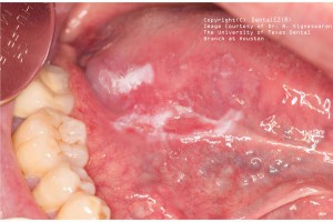 oral cancer